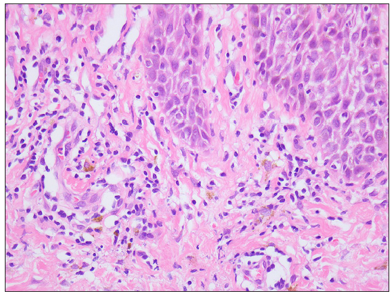 Patient 8: Epidermal hyperkeratosis, parakeratosis, irregular epidermal thickening, necrosis of superficial keratinocytes, intercellular edema, lymphocyte migration, basal cell degeneration, perivascular infiltrate of lymphohistiocytic cells and neutrophils, and nuclear dust (Haematoxylin & Eosin, 400x).