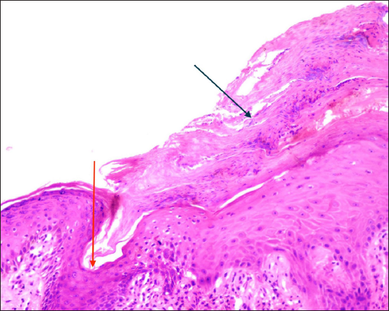 Focal actinic porokeratosis over nose successfully treated with topical ...