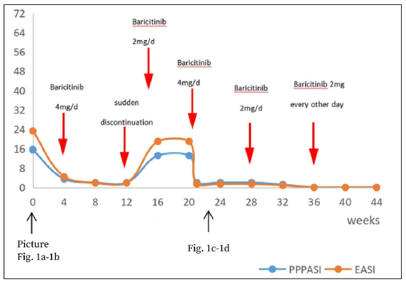 Eczema Area and Severity Index (EASI) for truncal rash, and Palmoplantar Pustulosis Area and Severity Index (PPPASI) for palmoplantar lesions decreased significantly post baricitinib and increased again after sudden discontinuation. EASI and PPPASI decreased when barictinib was continued after relapse, and both remained unchanged when the dosage was gradually reduced after a marked improvement in skin lesions.