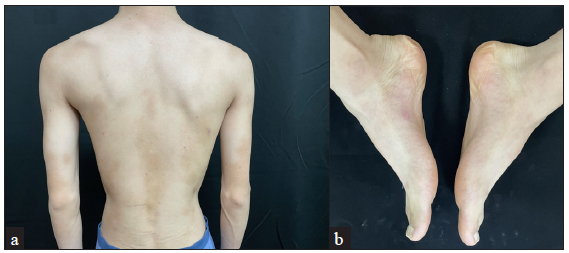 (a) Resolution of the truncal lesions. (b) Resolution of plantar lesions.