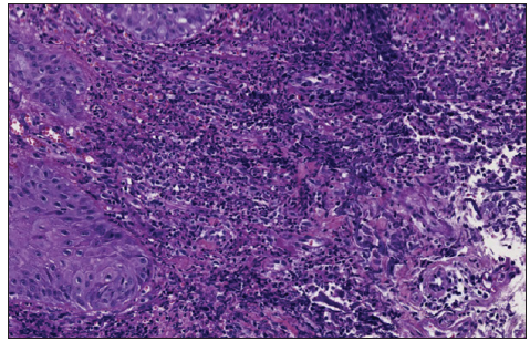 Dense dermal neutrophilic infiltrate (Haematoxylin and eosin stain, x40).