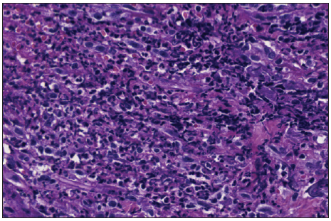 Dense dermal neutrophilic infiltrate (Haematoxylin and eosin stain, x100).