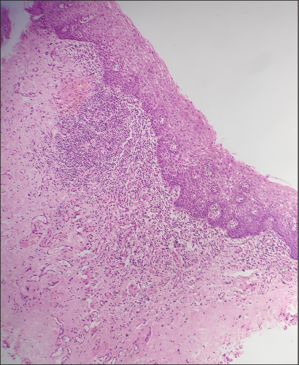 Acanthosis and band-like dense infiltrate (H&E, 40×).