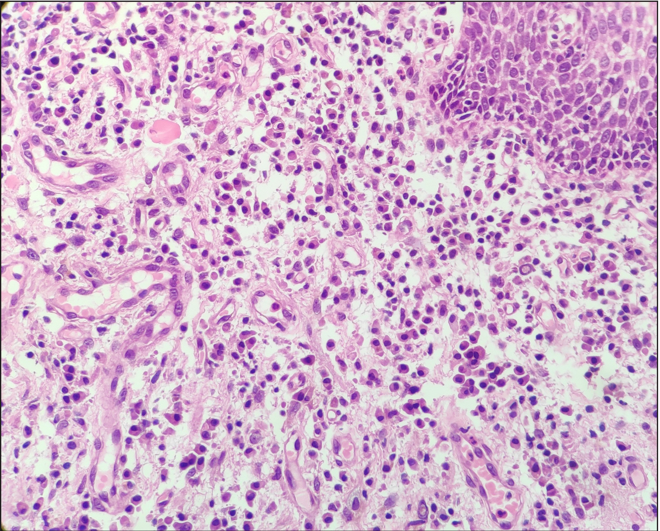 Dense inflammatory infiltrate of plasma cells (H &E, 400×).