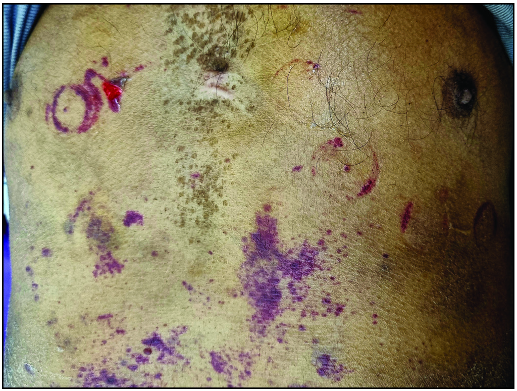 Purpura on the chest at the site of ECG electrodes and upper abdomen. Note the skin peeling over a purpura on the right chest.