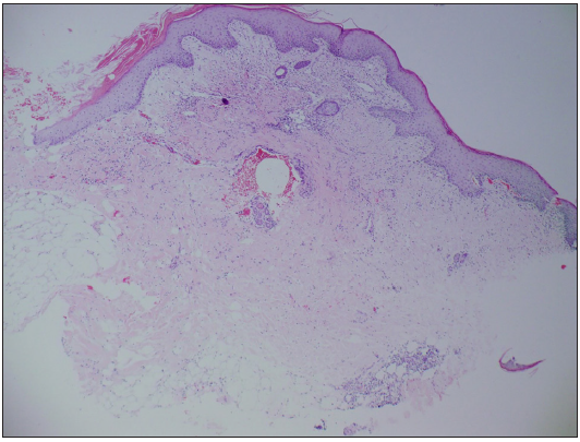 Acute and chronic inflammatory cells were visible around the ulceration (Haematoxylin & Eosin, 50x).