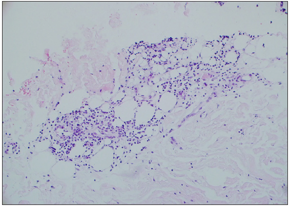 Subcutaneous fat necrosis with an infiltrate of lymphocytes, histiocytes, and a few plasmacytes (Haematoxylin & Eosin, 200x). Lipodystrophia centrifugalis abdominals infantilis presenting as a giant ulceration and treatment with hydroxychloroquine and baricitinib