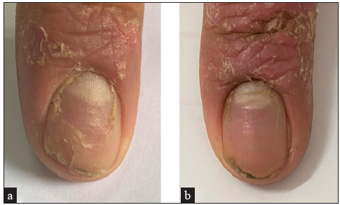 Right index psoriatic nail of a 42 years old male (a) Crumbling before treatment with Intense pulsed light (IPL) clinically. (b) Improvement three months after the last session clinically.