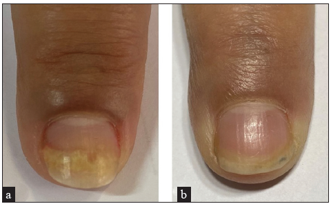 Right index psoriatic nail. Right index psoriatic nail of a 23 years old female (a) Onycholysis before treatment with Pulse dye laser (PDL) clinically. (b) Improvement of onycholysis three months after last session clinically.