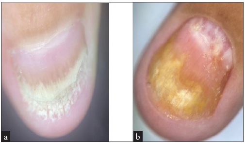 Dry onychoscopy (10x) of psoriatic fingernails. (a) Oil drop, distal onycholysis and subungual hyperkeratosis. (b) Distal onycholysis, oil drops and red spots in lunula.