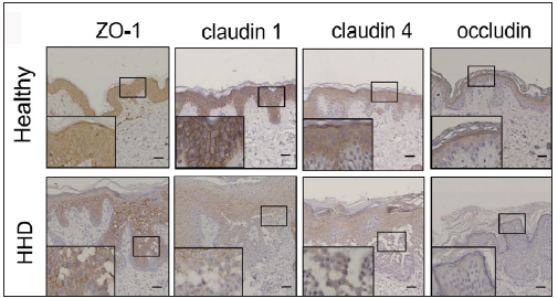 SPCA1, cytoskeletal, and tight junction proteins are poorly expressed in the skin lesions of patients with HHD. Immunohistochemistry (IHC) was performed for the protein expression in the paraffin sections. HHD, Hailey– Hailey disease; ZO-1, zonula occludens protein 1.