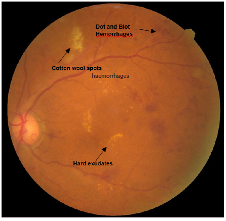 Fundus examination showing findings (black arrows suggesting dot and blot haemorrhages, cotton wool spots and hard exudates) suggestive of moderate nonproliferative diabetic retinopathy.