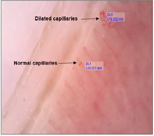 Nail fold capillaroscopy showing normal capillaries and dilated capillaries. (black arrow). [195.1 X] (DL0 – first dermoscopic calibration, DL1 – second dermoscopic calibration, H – represents the line used during the calibration.)