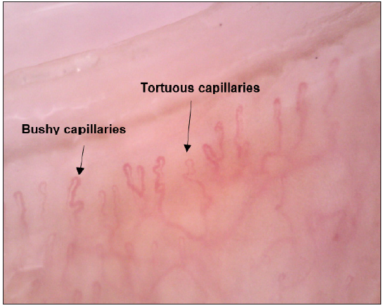 Nail fold capillaroscopy showing bushy capillaries and tortuous capillaries. (black arrow). [203.1x]