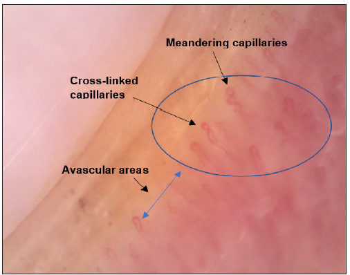 Nail fold capillaroscopy showing cross-linked (black arrow, blue circle), meandering capillaries (black arrow, blue circle) and avascular areas (blue arrow). [203.6 X]