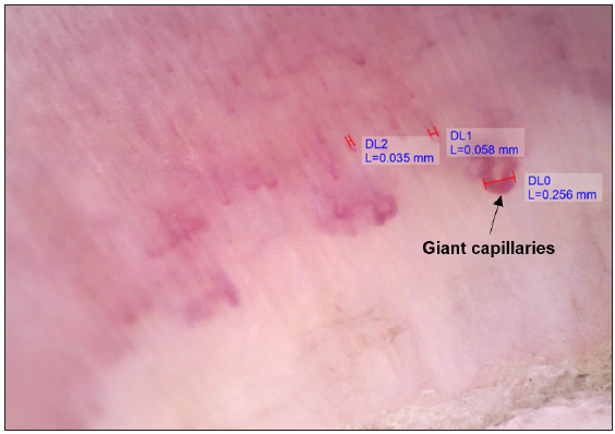 Nail fold capillaroscopy showing dilated and giant (black arrow) capillaries. [71.4x]. DL0: first dermoscopic calibration, DL1: second dermoscopic calibration, DL2: third dermoscopic calibration, H (red lines) signify the line used during calibration.