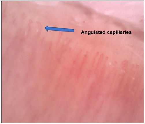 Nail fold capillaroscopy showing angulated capillaries (blue arrow). [149.8x]