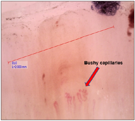 Nail fold capillaroscopy showing reduced capillary density and bushy capillaries (red arrow). [155.5x]. DL0: dermoscopic calibration used. H (red line) signify the line used during calibration.