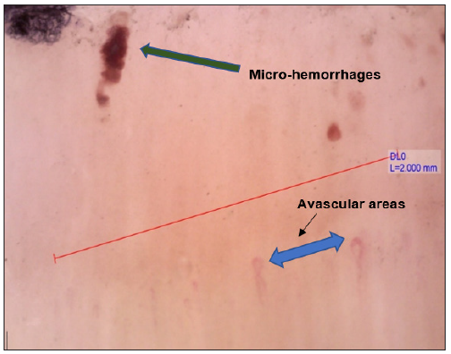 Nail fold capillaroscopy showing reduced capillary density, microhaemorrhages (green arrow) and avascular areas (blue arrow). [155.5x]. DL0: dermoscopic calibration used. H (red line) signify the line used during calibration.