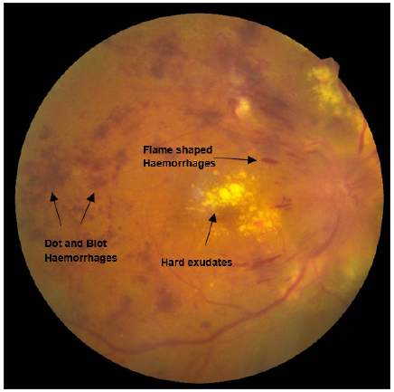 Fundus examination showing findings suggestive of proliferative diabetic retinopathy with clinically significant macular oedema (CSME). Black arrows suggesting dot and blot haemorrhages, flame shaped haemorrhages and hard exudates.