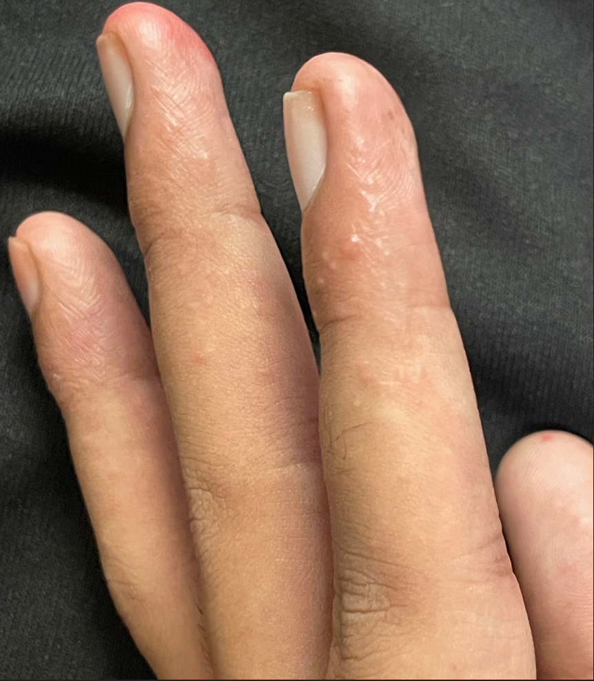 Multiple discrete shiny vesicles on the fingers of the right hand associated with excessive sweating