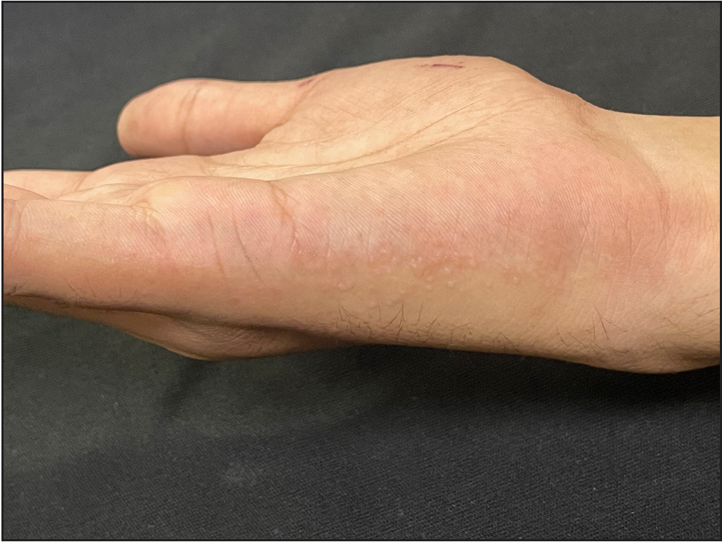 Multiple discrete shiny vesicles over the inner aspect of the right hand associated with excessive sweating