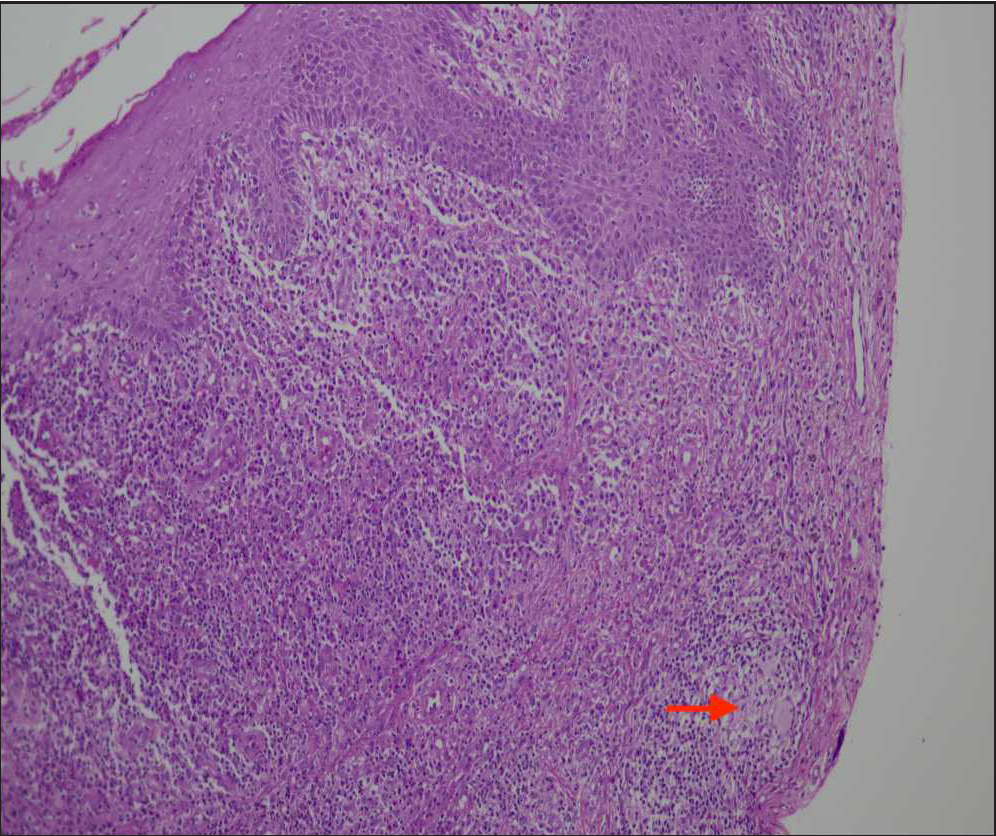 Haematoxylin & eosin (H&E) staining at 100× showing hyperplastic squamous epithelium in left and upper half of the image, the lower half showing dense mixed inflammation and a non-necrotizing epithelioid cell granuloma (red arrow) at the lower end of the image.