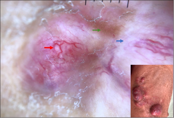 Linear and arborizing telangiectasia (red arrow), pigment network (green arrow) and white structureless areas (blue arrow). Inset: Clinical presentation of DFSP over leg.