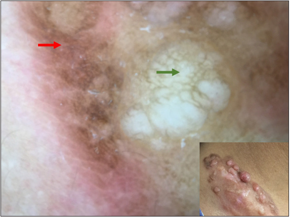 Pigment network (red arrow) and yellowish structureless areas (green arrow). Inset: Clinical presentation of DFSP over supraclavicular area.