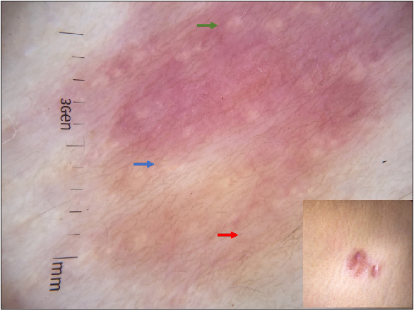 Dermoscopy of atrophic DFSP; yellow globules (green arrow) and yellowish structureless area (blue arrow) over pink background with prominent pigment network (red arrow). Inset: Clinical presentation of DFSP over pre-sternal area.