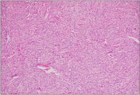 Dermal tumour cells of DFSP arranged in storiform pattern (Haematoxylin and eosin, ×400).