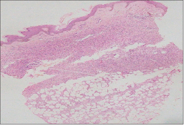 Atrophic DFSP; showing focal Focal epidermal atrophy and dermal tumour cells extending to subcutaneous tissue (Haematoxylin and eosin, ×100).