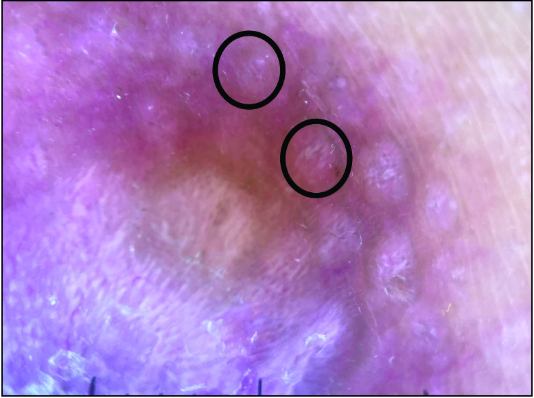 Dermoscopic presentation. Grouped erythematous doom-shaped papillary excrescence at the borders (black circles).