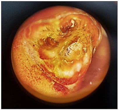 On onychoscopy, whitish yellow structureless areas, somewhat arranged in a whorled pattern with adherent whitish scaling were seen (Heine Delta 20T, magnification 10x).