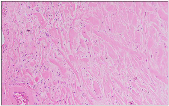 Histopathology showed haphazardly arranged bundles of homogenously eosinophilic thick collagen (Haematoxylin and Eosin, 100x).