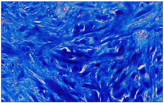 The thick collagen bundles are more apparent on Masson’s Trichrome (Masson’s trichrome, 200x).