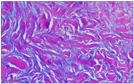 Presence of mucin between the collagen bundles highlighted on Alcian Blue stain (Alcian Blue-Periodic acid-Schiff, 200x).