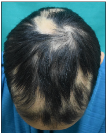 Baseline image of a 12-year-old girl with alopecia areata.