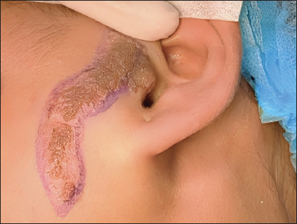 A linear plaque of naevus sebaceous on the left preauricular area.