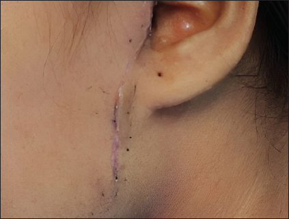 The preauricular area 2 weeks’ post-removal of naevus sebaceous plaque.