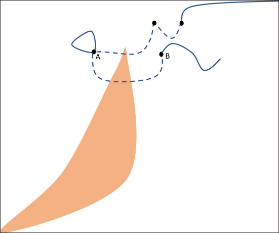 The needle re-enters the skin through the same exit point (point A) to exit at the far opposite end (point B) in a deeper plane (far-far).