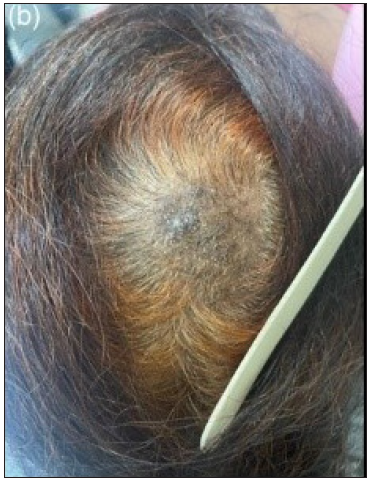 A delineated alopecic patch present over the vertex with broken hair shafts and background lichenification.