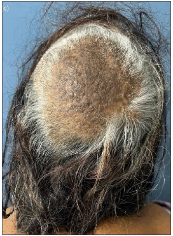 Well-defined, alopecic patch over vertex and occiput with background lichenification.