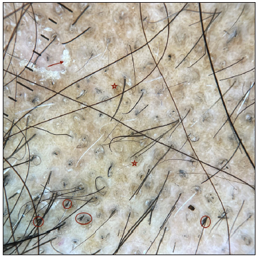 Trichoscopy (patient 1)- blackdots, broom fibres (red circle) with white perifollicular scales (red arrow) and perifollicular brown halo (red star). (Dermlite DL4, non polarised, 10x).