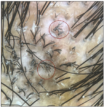 Multiple broom fibres (red circle) along with perifollicular scales in the trichoscopy of patient three. (Dermlite DL4, (Non-polarised, 10x).