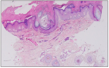 Histopathology (patient 1) showing hyperkeratosis, acanthosis, hypergranulosis, dermal inflammation and perifollicular fibrosis. (Haematoylin and eosin, 40x).