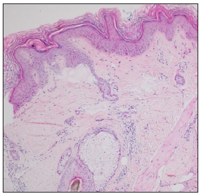 Patient 2- Hyperkeratosis, acanthosis and dermal inammation (Haematoxylin and eosin, 200x).