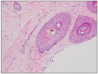 Patient 3- Characteristic hamburger signs with the splitting of the hair shaft due to hyperkeratosis at the level of the infundibulum with background perifollicular fibrosis and inammation (Haematoxylin and eosin, 400x).