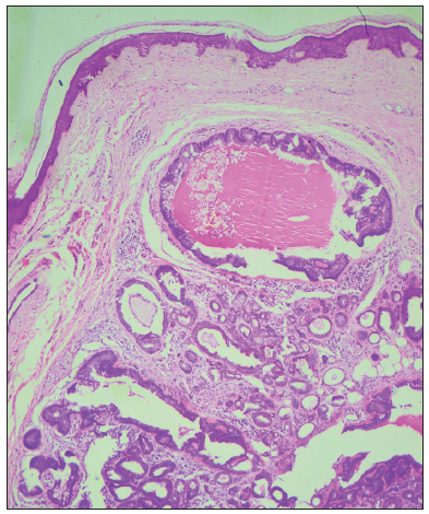 Dermal tumour composed of variably sized tubular structures containing pink material in the lumen with adjacent stroma composed of collagen (Haematoxylin and Eosin, 40x).