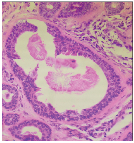 Tubular structures lined by doubled-layered epithelium (Haematoxylin and Eosin, 400x).